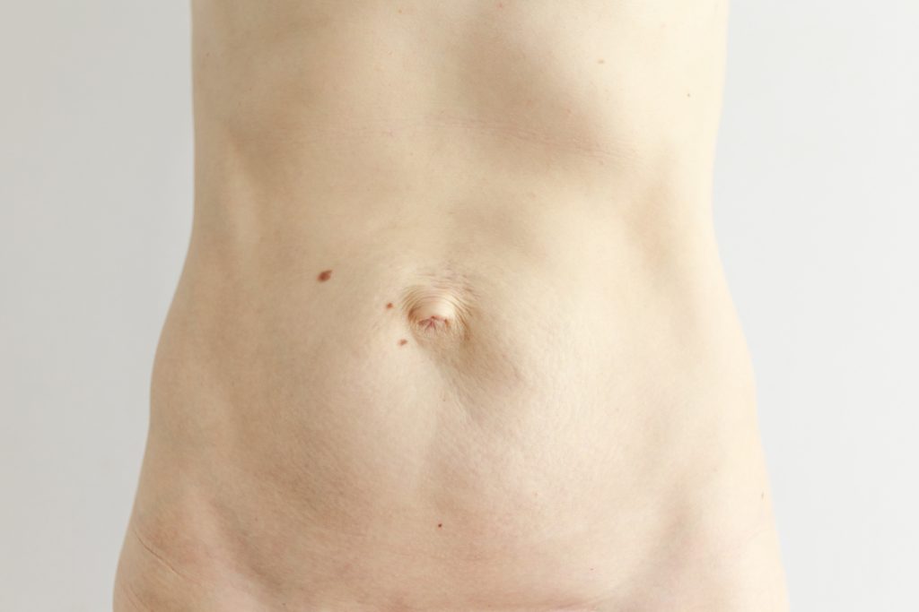 Umbilical Hernia: Should I Have Surgery?