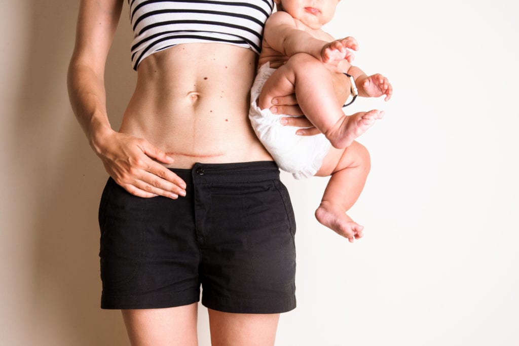 Exercises to Avoid After a C Section. Woman with child and c section scar. Every Mother.