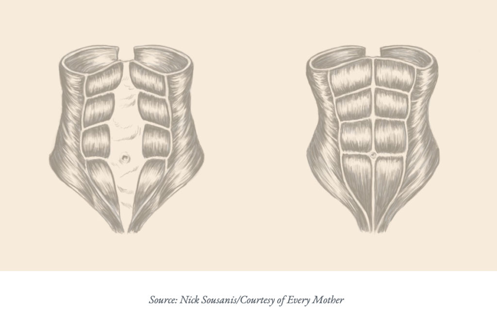 Diastasis Recti 101 Every Mother